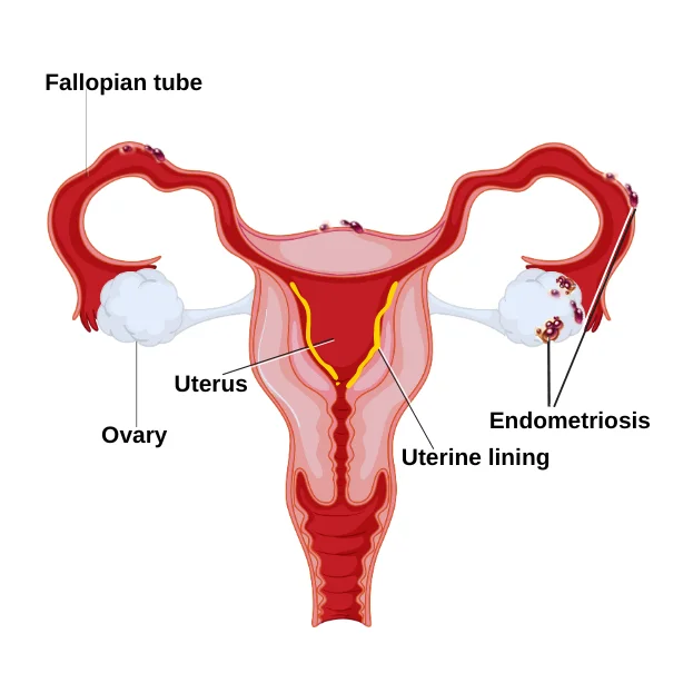 A labeled diagram of the female reproductive system, including the uterus, fallopian tubes, ovaries, endometrium/uterine lining, and endometriosis